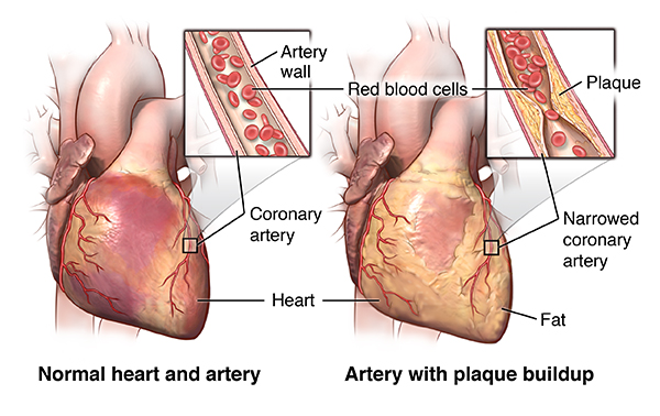 How can coronary heart disease be prevented?